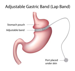 Laparoscopic-Adjustable-Gastric-Banding